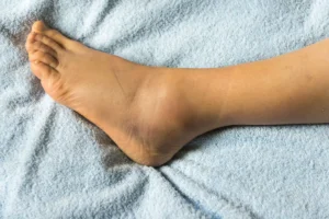 Picture of a swollen ankle.