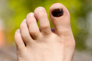 big toe with black nail