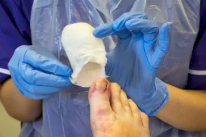 Image of blue-gloved pair of hands taking off a wrap from a toe in toenail removal aftercare