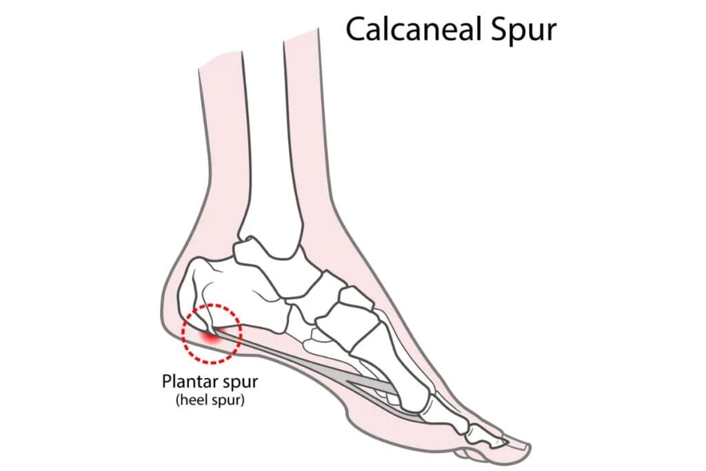 Heel Spurs Modern Foot Ankle