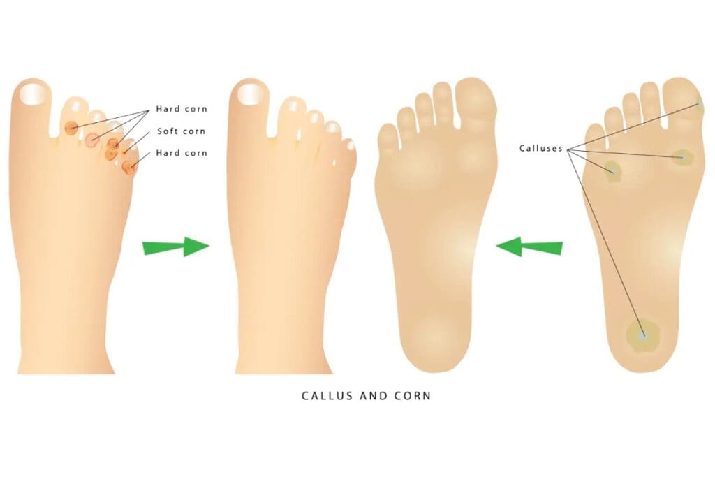 Callus removal on foot online