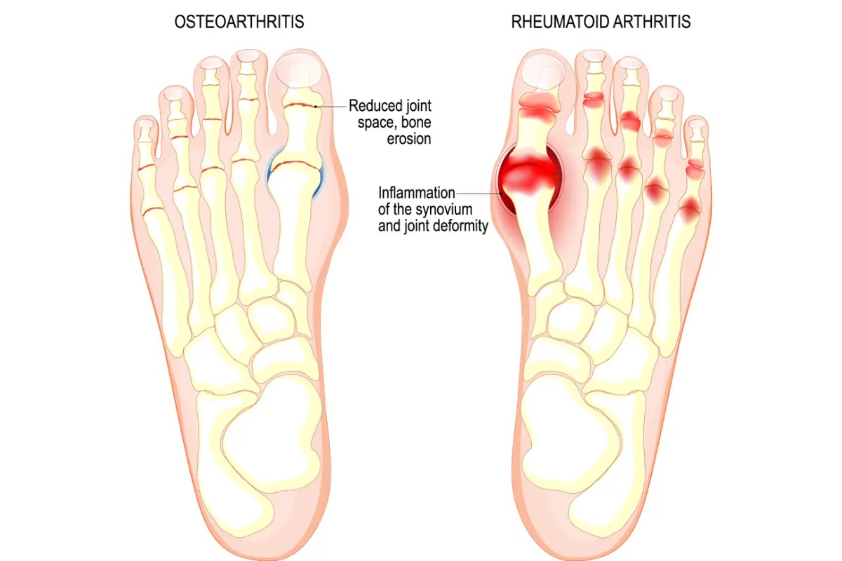 arthritis of big toe icd 10