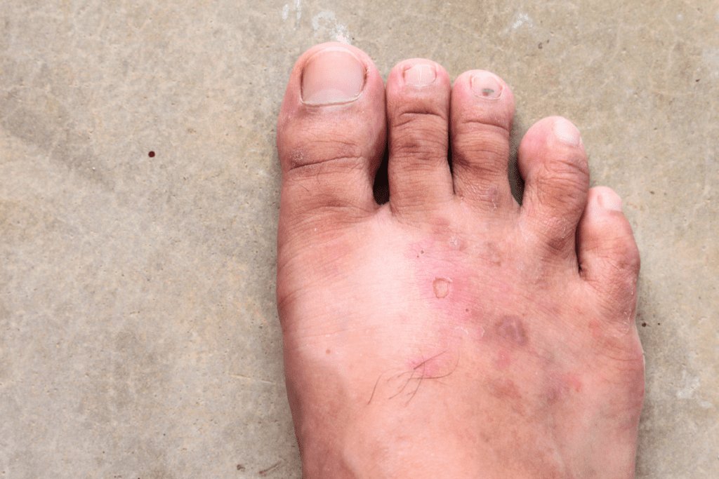 Close up image psoriasis on top of foot